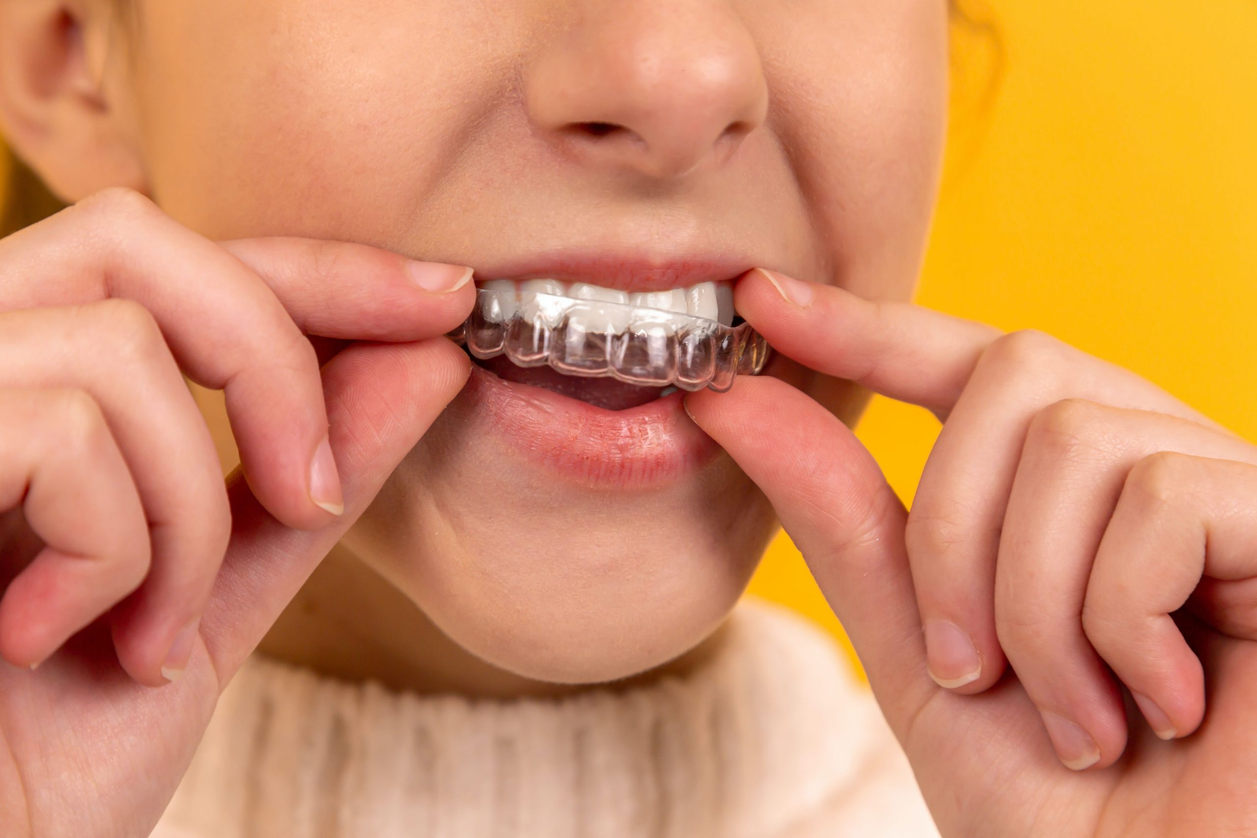 How much does Invisalign treatment cost? – Vancouver Orthodontics